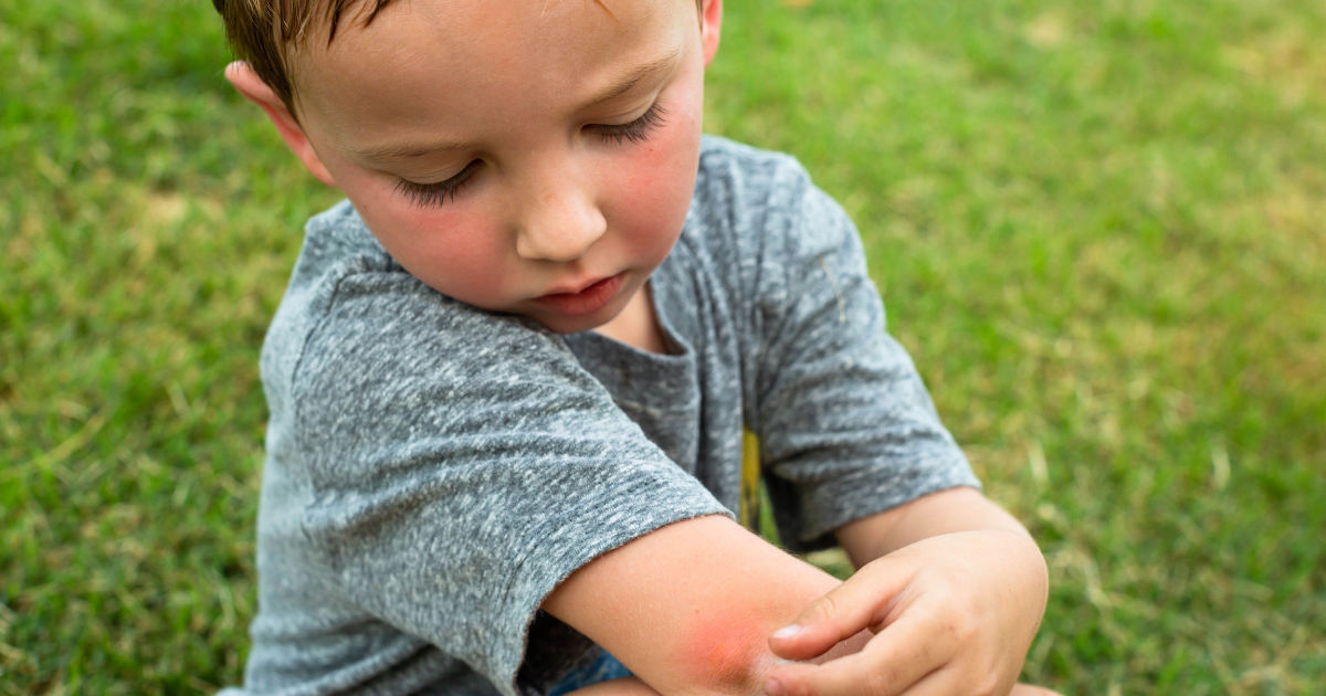 photo of a boy inspecting a bug bite on his arm. ant bites blog